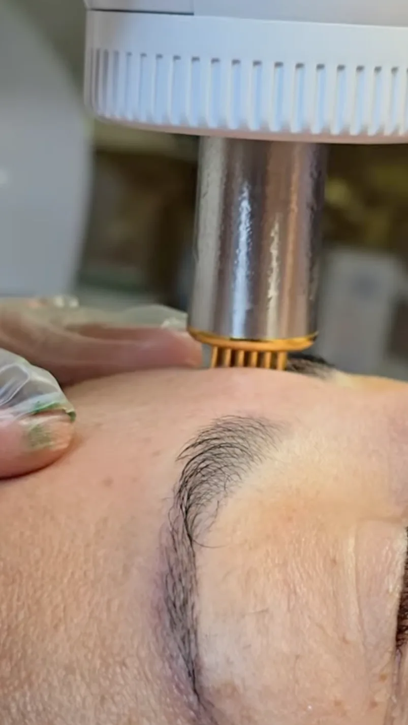 Detalhe do ponteira de Cryotecar em atendimento na Refinada Beauty